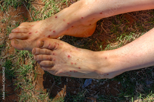 Feet and legs of a woman with midge bites, bitten by hundreds of midges in Western Australia photo