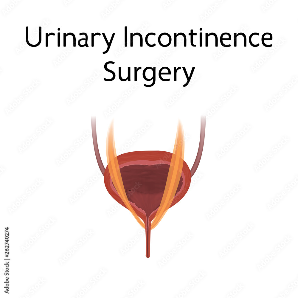 Anatomy picture of Urinary incontinence surgery. Realistic medical ...