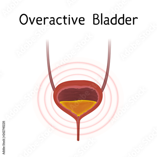 Anatomy picture of Overactive bladder. Realistic medical illustration.