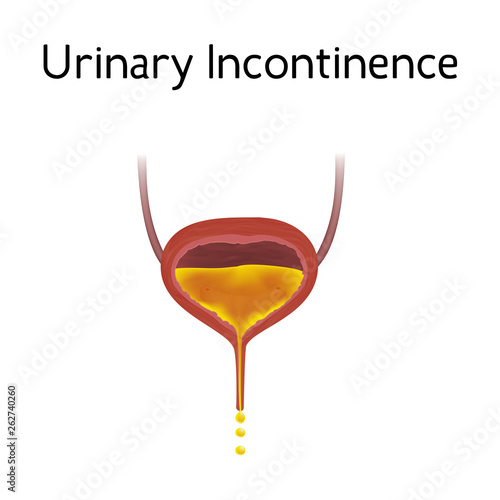 Anatomy picture of Urinary incontinence. Realistic medical illustration.