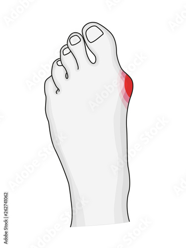 Hallux