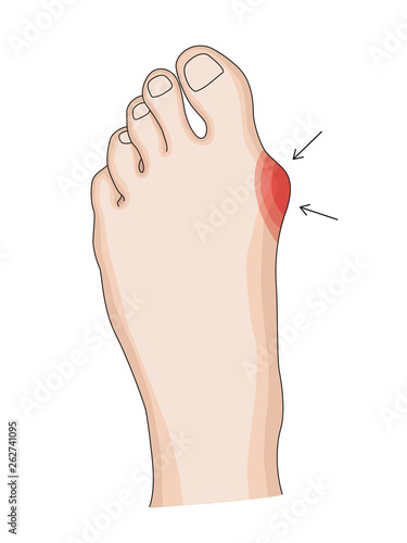 Hallux