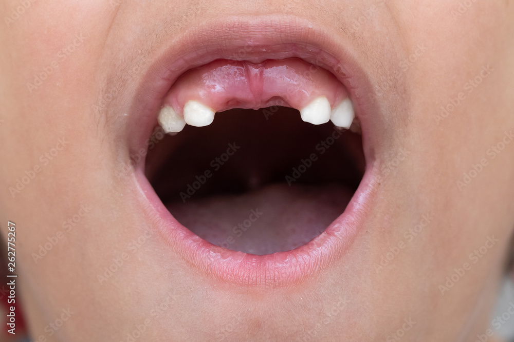 Obraz premium A closeup view of a young child who has lost his front teeth, tooth fairy and dental concept.