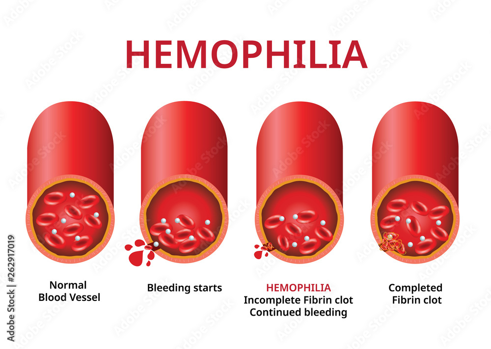Hemophilia. damaged blood vessel, Haemophilia (Coagulation disorder