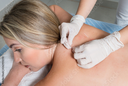 The doctor sticks needles into the blonde girl's body on the acupuncture.