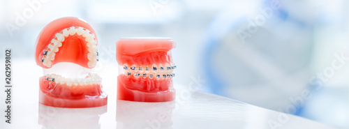Orthodontic model and dentist tool - demonstration teeth model of varities of orthodontic bracket or brace. Metal and ceramic braces on teeth on an artificial jaws closeup photo