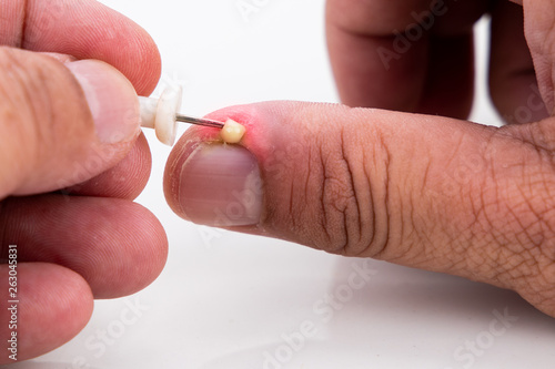 Series of painful finger nail skin infection with pus reatment photo