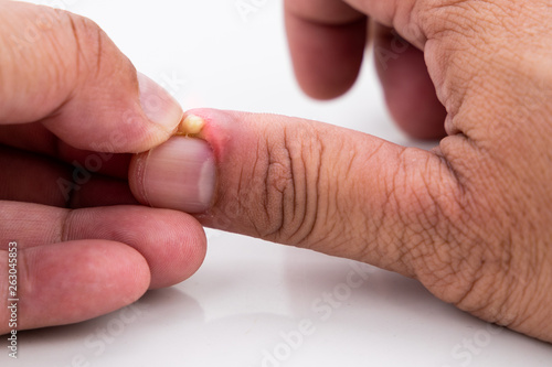 Series of painful finger nail skin infection with pus reatment