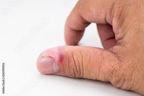 Series of painful finger nail skin infection with pus reatment photo