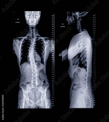 X-ray image of Whole human Spine comparison AP nad Lateral view showing scoliosis of thoracic spine.