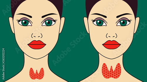 Normal and enlarged thyroid gland