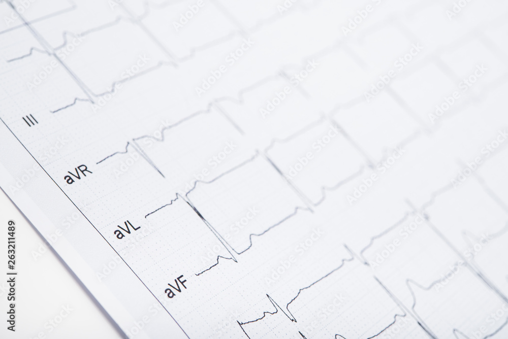 Closeup photo of ECG cardiogram Closeup photo of ECG cardiogram