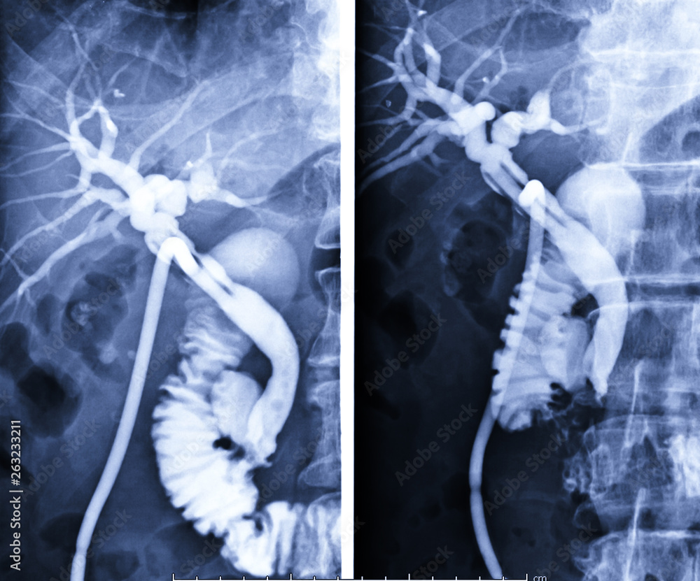 A T-tube cholangiogram is a fluoroscopic procedure in which contrast medium  is injected through a T-tube into the patient's biliary tree comparison AP  and Oblique view. Stock Photo