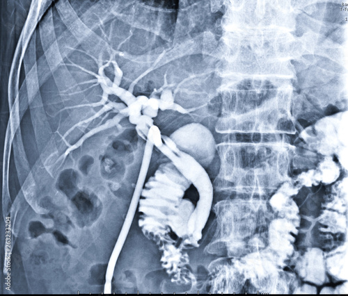 A T-tube cholangiogram is a fluoroscopic procedure in which contrast medium is injected through a T-tube into the patient's biliary tree. photo