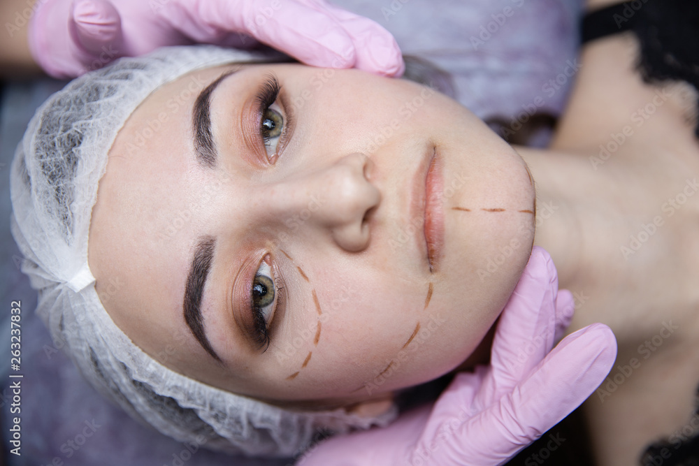 Preparation for plastic surgery. Young model in the clinic with perforation lines on her face Preparation for plastic surgery. Young model in the clinic with perforation lines on her face