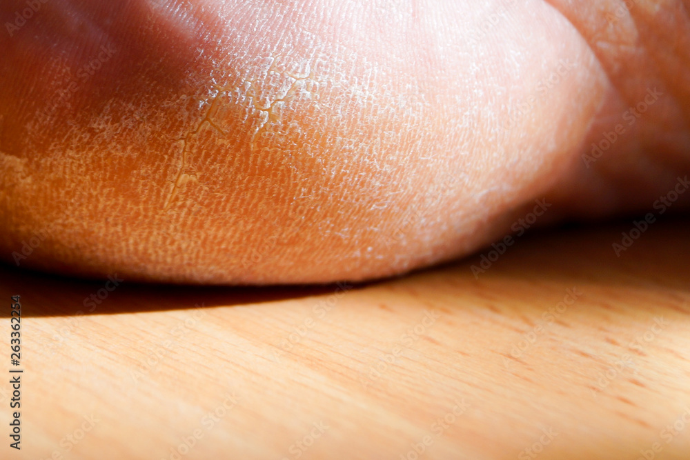 Fototapeta premium Closeup image of a heel on the foot with a white callus.