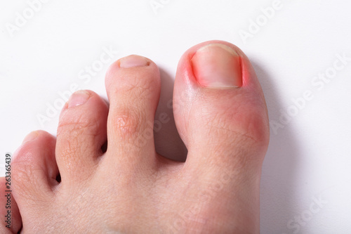 Wall Mural Close-up Of Sore Toe Nail