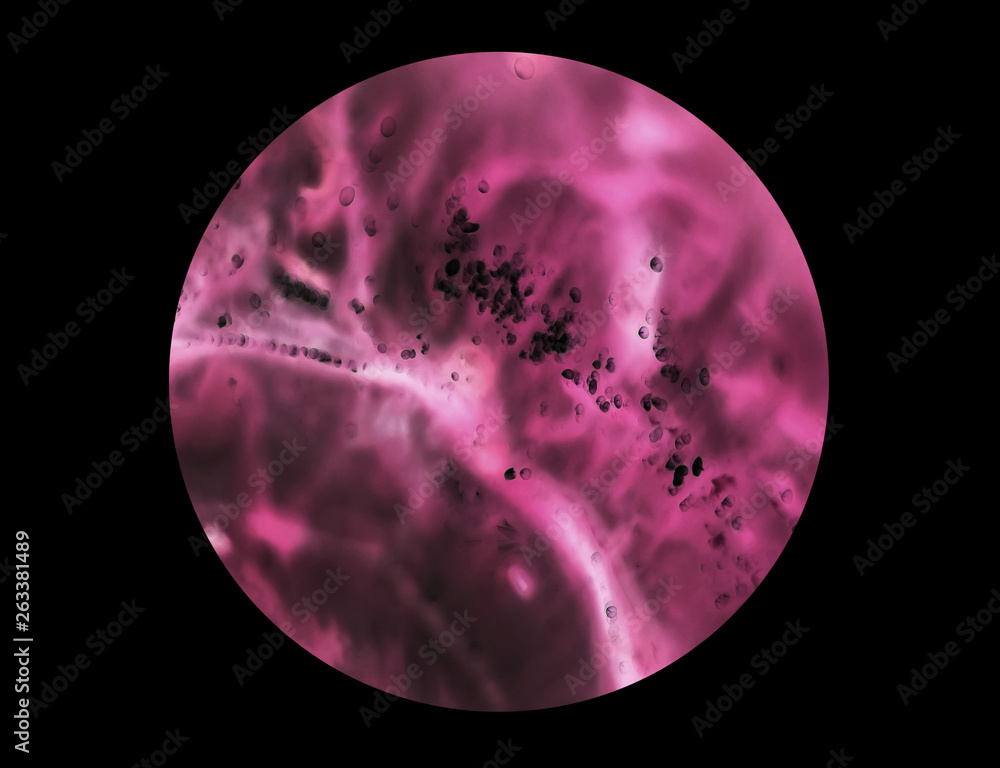 cancer cells under a microscope. Tissues affected by cancer cells under the microscope, Science. Cancer drugs. chemistry cancer cells under a microscope. Tissues affected by cancer cells under the microscope, Science. Cancer drugs. chemistry
