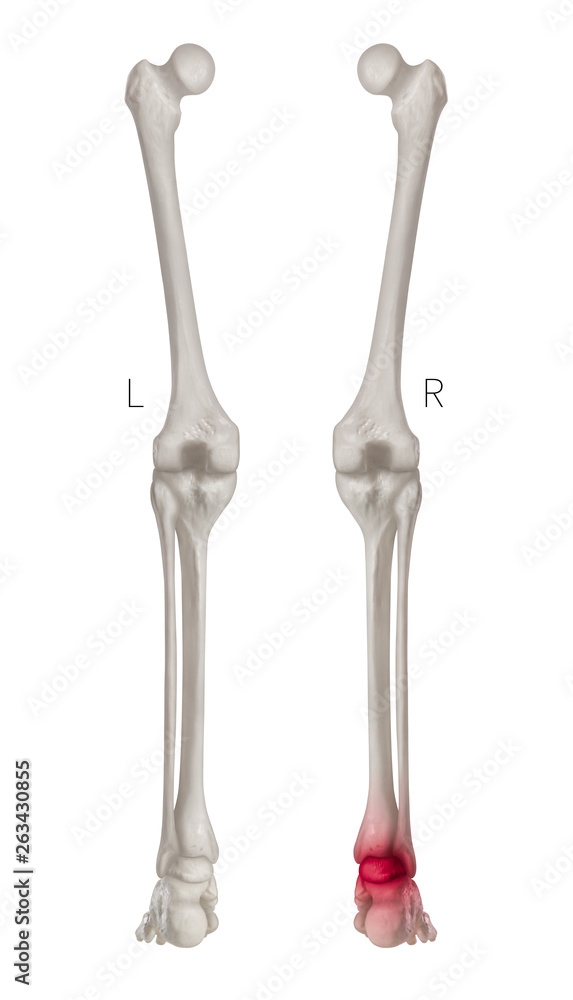 Human Leg bone left and right- Posterior view red highlights in arthritis Ankle joint pain area- 3D Medical- Biomedical illustration- Human Anatomy and Medical Concept- Isolated white background Human Leg bone left and right- Posterior view red highlights in arthritis Ankle joint pain area- 3D Medical- Biomedical illustration- Human Anatomy and Medical Concept- Isolated white background