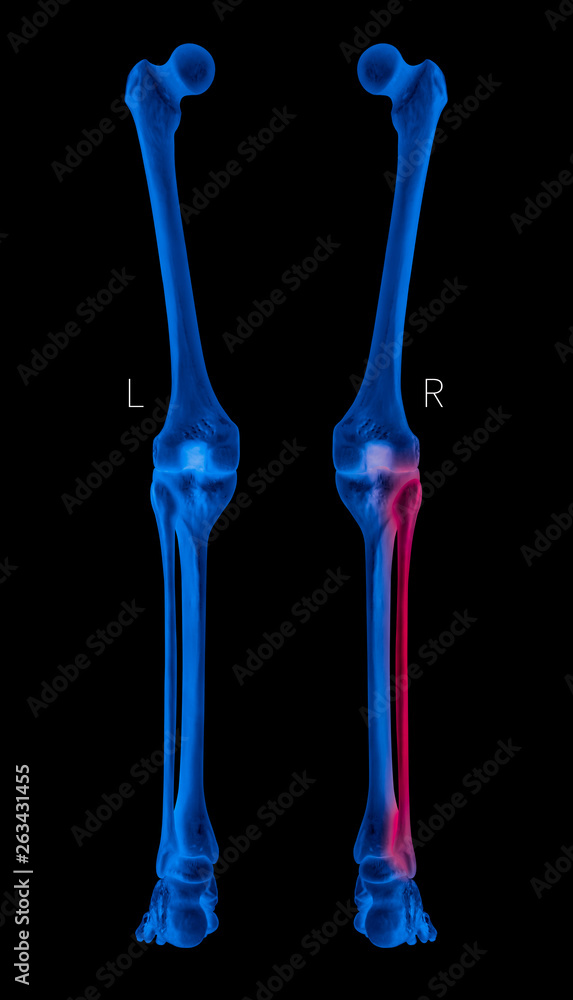 X-ray of Human Leg bone left and right- Posterior view red highlights in Fibula bone pain area- 3D Medical and Biomedical illustration- Healthcare- Human Anatomy and Medical Concept- Blue tone color X-ray of Human Leg bone left and right- Posterior view red highlights in Fibula bone pain area- 3D Medical and Biomedical illustration- Healthcare- Human Anatomy and Medical Concept- Blue tone color
