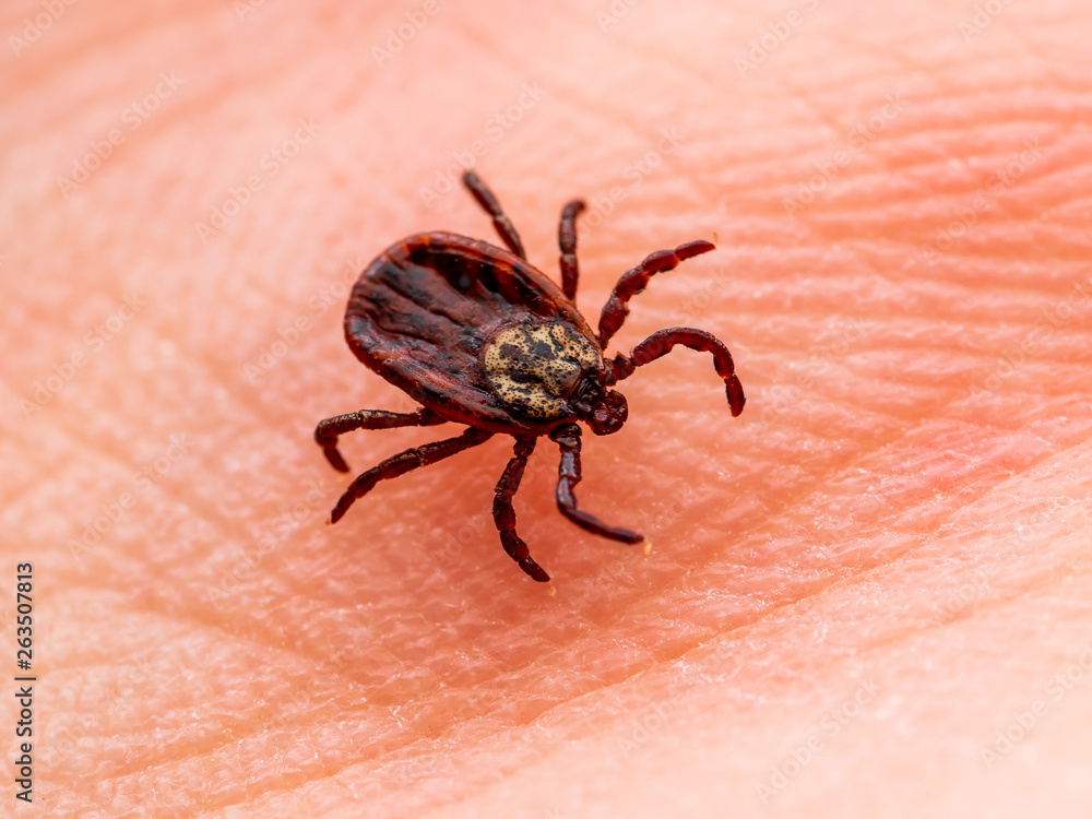 Encephalitis Virus or Lyme Borreliosis Disease Infectious Dermacentor Tick Arachnid Parasite Insect on Skin Macro Encephalitis Virus or Lyme Borreliosis Disease Infectious Dermacentor Tick Arachnid Parasite Insect on Skin Macro