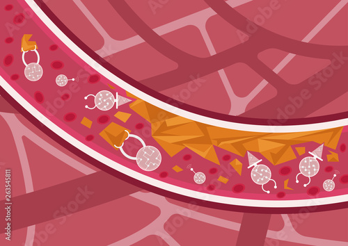 Future of medicine. Nanobots in action. Nanorobots detecting, destroying and eliminating cholesterol plaques in blood vessels