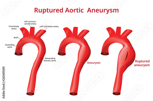 Ruptured Aortic Aneurysm, Aortic Disease, Vector