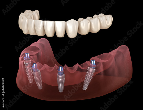 Obraz na płótnie Mandibular prosthesis All on 4 system supported by implants