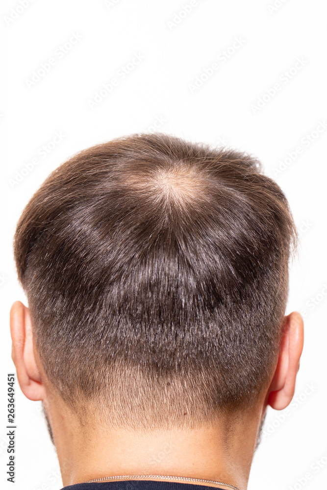 Hair loss concept. Young man with bald head, hair loss - Image  