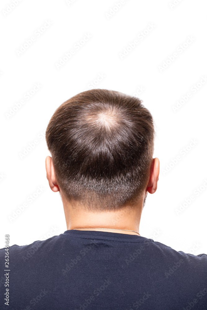 Hair loss concept. Young man with bald head, hair loss - Image Hair loss concept. Young man with bald head, hair loss - Image