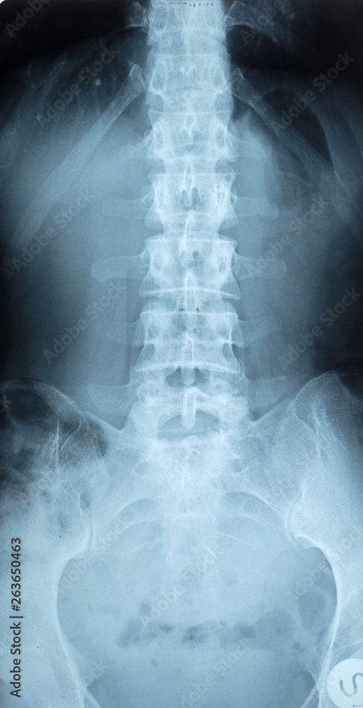 X-ray of pelvic bones and human spine. X-ray of pelvic bones and human spine.