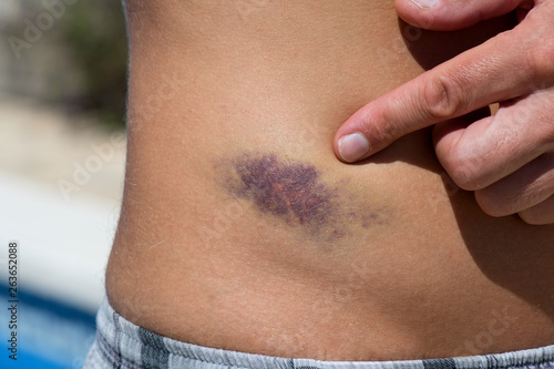 Detail of big bruise on man body