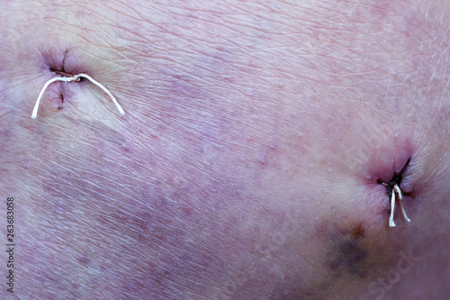 stitches in knee scar by arthroscopy operation at meniscal tear photo