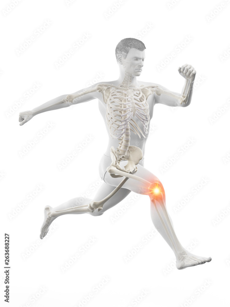 3d rendered medically accurate illustration of a runners painful kee