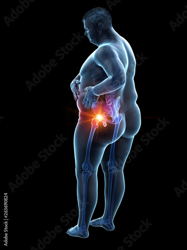 3d rendered medically accurate illustration of an obese mans painful hip joint