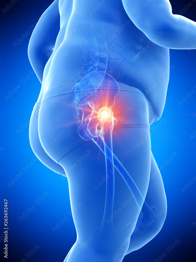 3d rendered medically accurate illustration of an obese runners painful hip 3d rendered medically accurate illustration of an obese runners painful hip