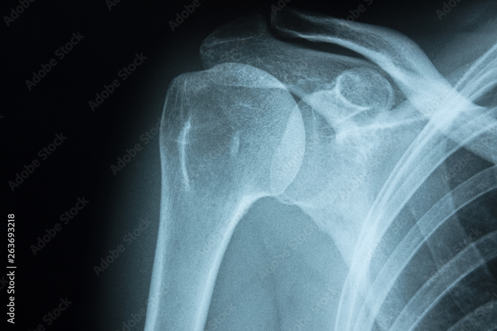 Detail of x-ray of human shoulder bones