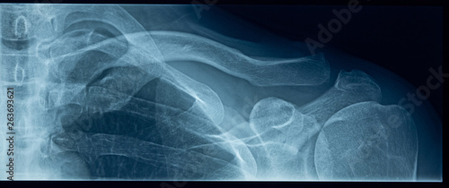 Wallpaper Mural Detail of x-ray of human shoulder bones Torontodigital.ca