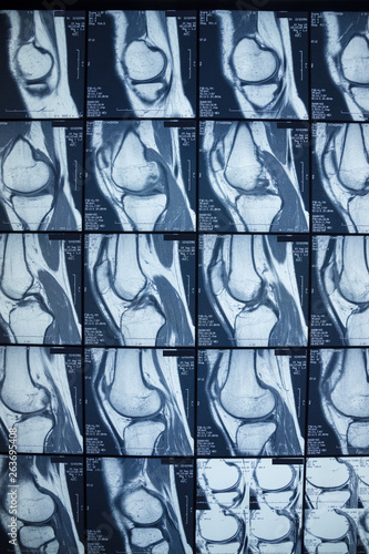 R.M.N. Nuclear magnetic resonance, of human knees, with cross-section and sagittal section. photo