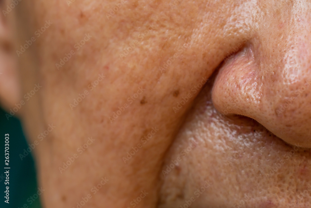 Acne, Small pimple is on senior woman's nose, Deep groove cheeks, Close up and macro shot, Selective focus, Asian Body skin part, Healthcare and Beauty concept Acne, Small pimple is on senior woman's nose, Deep groove cheeks, Close up and macro shot, Selective focus, Asian Body skin part, Healthcare and Beauty concept