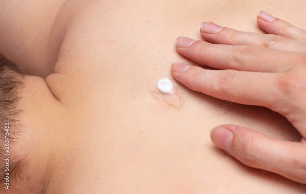 Fototapeta premium A girl smears a scar on a man's body with a healing ointment with hormones for healing scars and scars, close-up