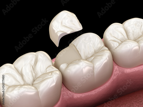Foto Onlay ceramic crown fixation over tooth