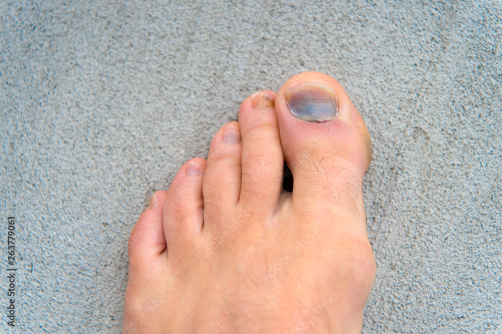 Injury of toe nail. Effects wearing footwear. Nail