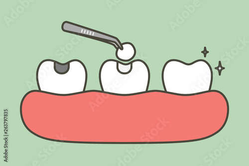 step of tooth amalgam filling by dental tools to protection decay tooth, before and after - teeth cartoon vector flat style photo