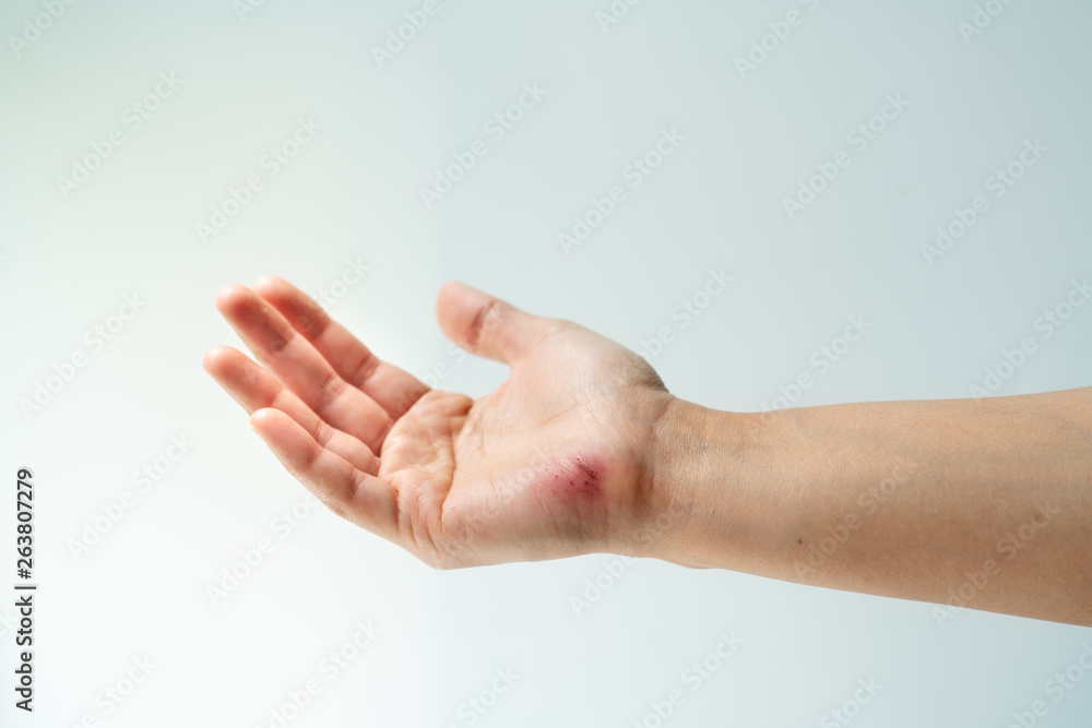 scratch wound on female hand closeup, healthcare and medicine concept