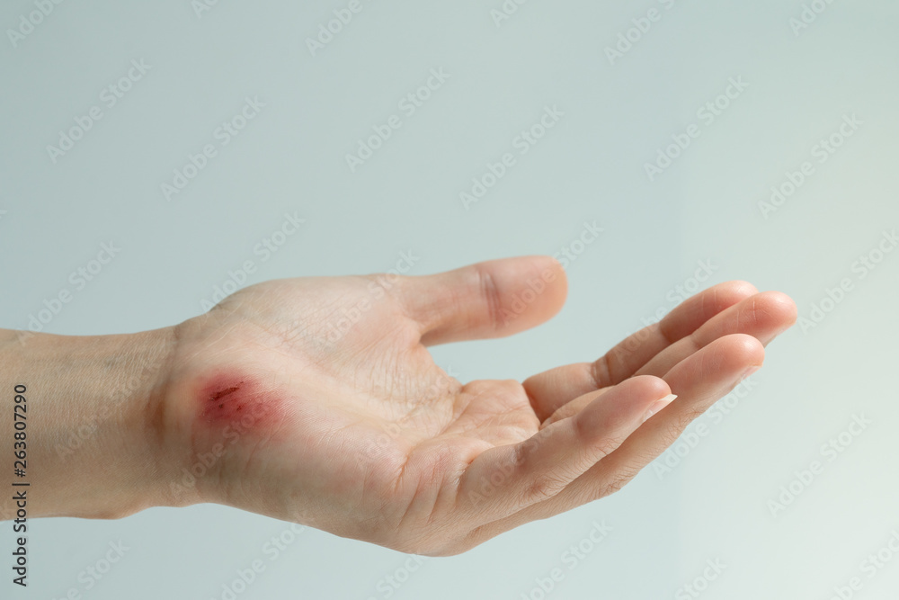 scratch wound on female hand closeup, healthcare and medicine concept - obrazy, fototapety, plakaty 