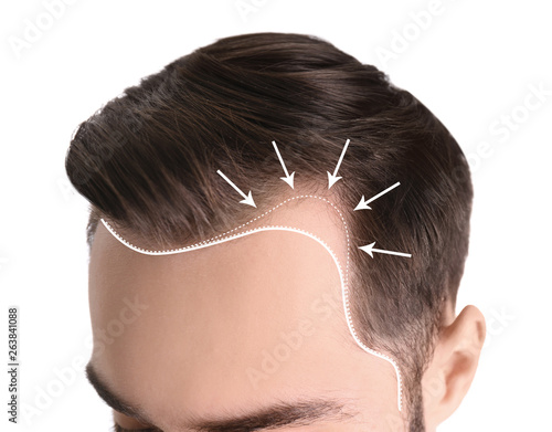 Young man with hair loss problem on white background, closeup