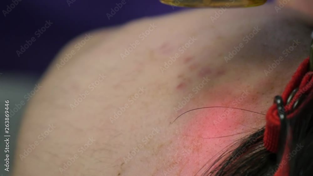 Extreme close-up of facial laser hair removal Extreme close-up of facial laser hair removal