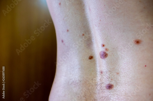 Melanocytic nevus, some of them dyplastic or atypical, on a caucasian man of 36 years old photo
