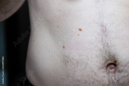 Melanocytic nevus, some of them dyplastic or atypical, on a caucasian man of 36 years old photo